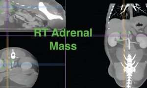 RT Adrenal Mass MPR Thick