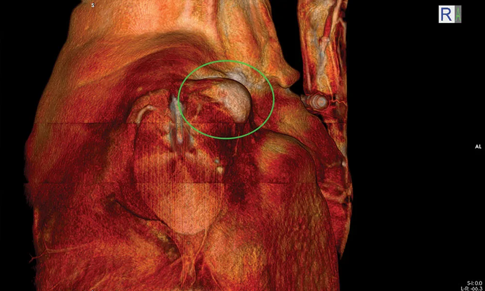 Right Shoulder Mass 3D Color
